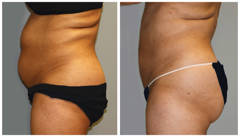 teen anal facial restoration in chicago