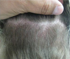 NeoGraft Method