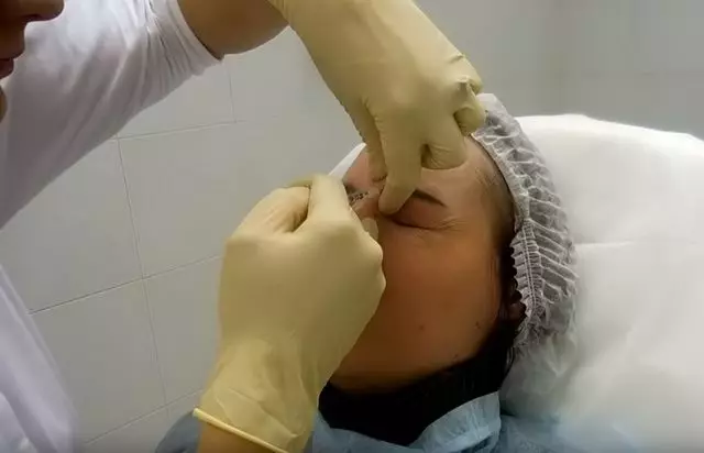 Botox injection Naperville IL