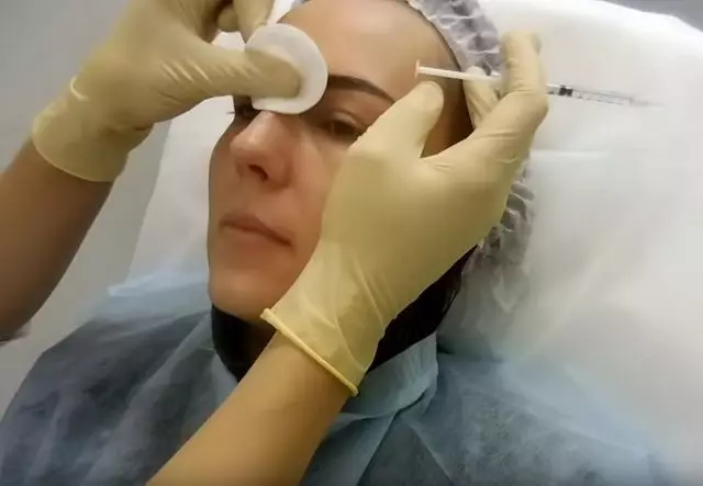 Botox injection Chicago IL